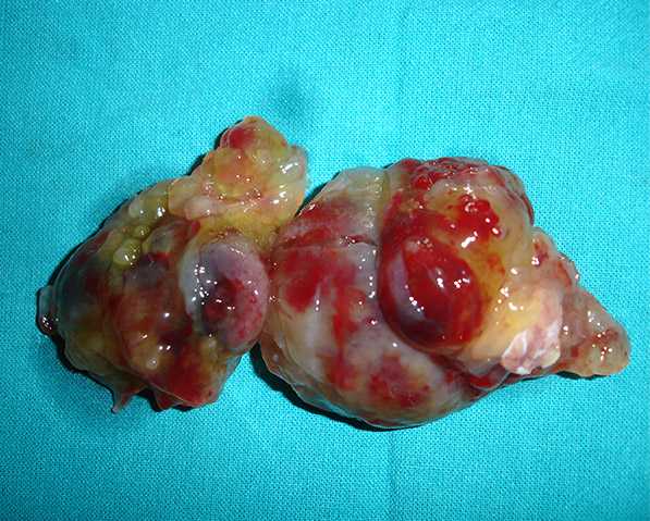 Cardiac Tumour